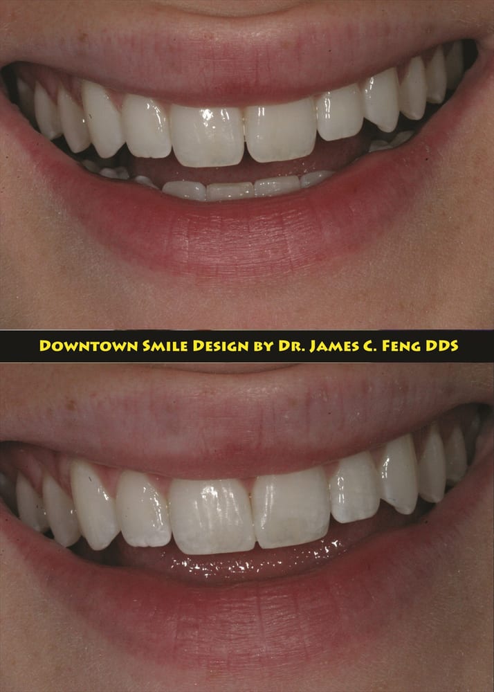 Bonding to improve and close up gap between her two front teeth. Yelp